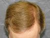 Click image for larger version

Name:	06b_after-hairline-restoration-top-view.jpg

Size:	70.7 KB
ID:	7114
