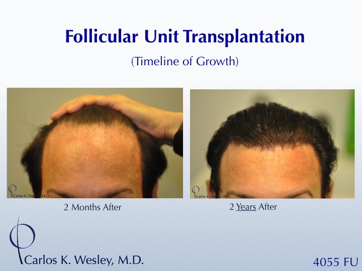 The timeline of hair growth (2 months versus 2 years) can be appreciated in these images from a patient receiving 4055 grafts from Dr. Carlos K....