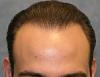 Click image for larger version

Name:	thumbs_04_after-1st-hair-transplant.jpg

Size:	14.8 KB
ID:	24957