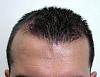 Before hair restoration with Dr. Dorin