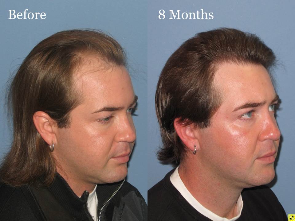 Paul Shapiro, MD 
FUT 1567 grafts 
8 months post-op