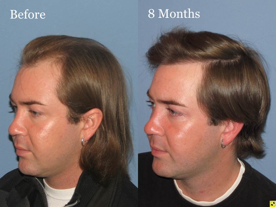 Paul Shapiro, MD 
FUT 1567 grafts 
8 months post-op