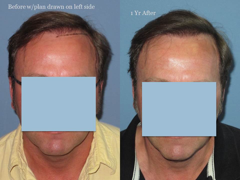 Dr. Paul Shapiro, MD 
FUT 2103 grafts 
 12 months post op