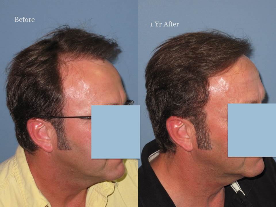 Dr. Paul Shapiro, MD 
FUT 2103 grafts 
 12 months post op