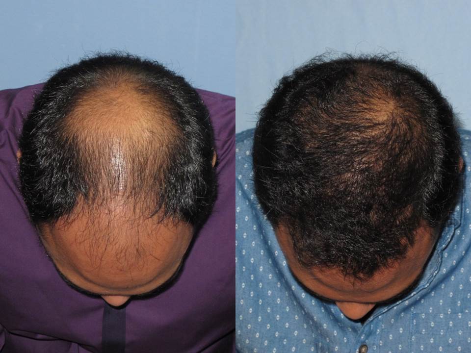 Dr. Paul Shapiro, MD 
FUT 4138 grafts 
12 months post-op