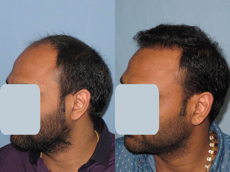 Dr. Paul Shapiro, MD 
FUT 4138 grafts 
12 months post-op