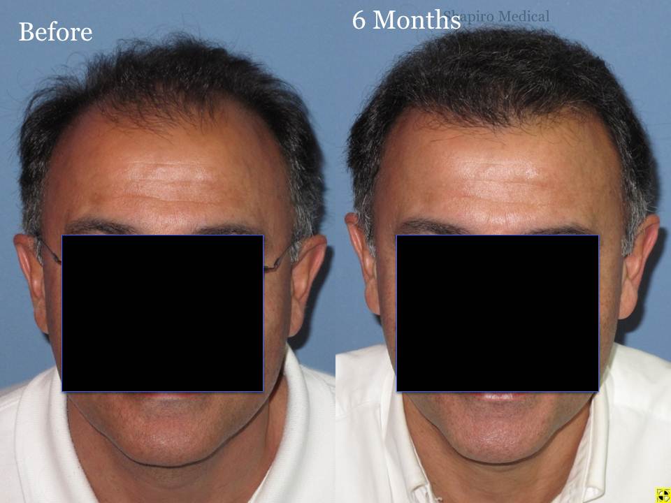 Dr. Paul Shapiro, MD 
FUT 2915 grafts 
6months post-op