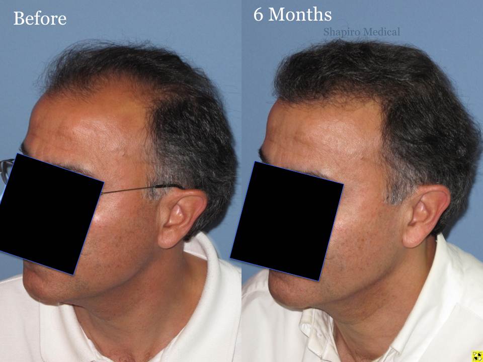 Dr. Paul Shapiro, MD 
FUT 2915 grafts 
6 months post-op