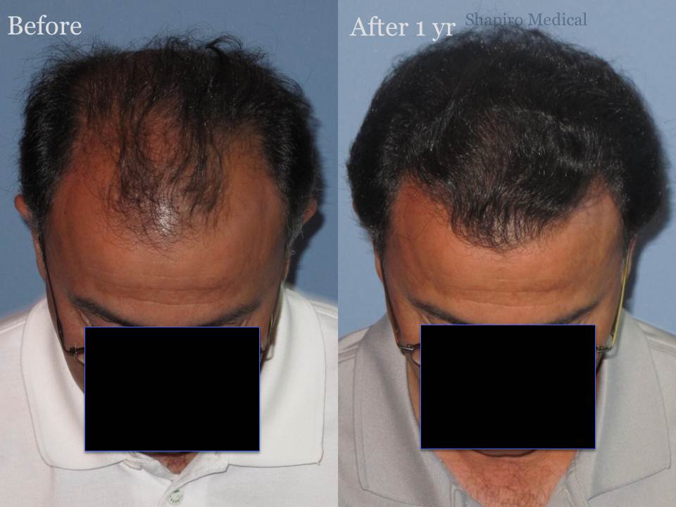 Dr. Paul Shapiro, MD 
FUT 2915 grafts 
12 months post-op