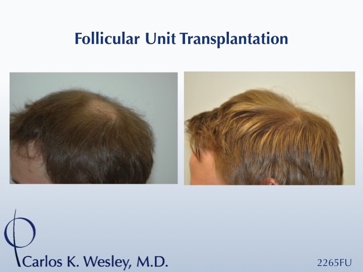 This 22-year-old can be seen before/after a 2265 grafts session to his mid scalp with Dr. Carlos K. Wesley 
 
An interactive before/after image of...