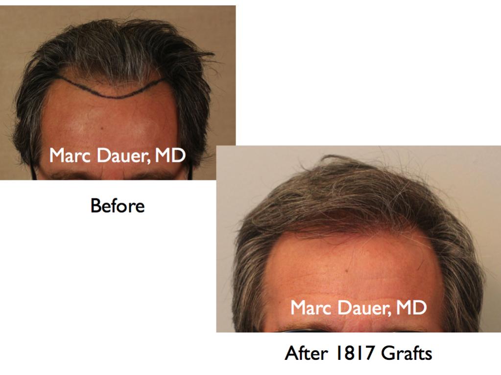 Click image for larger version

Name:	Hair Transplant Slides6.045.jpg

Size:	59.8 KB
ID:	23682