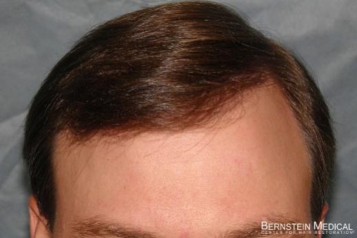 Click image for larger version

Name:	05_after-hair-repair-at-one-year.jpg

Size:	23.4 KB
ID:	18999