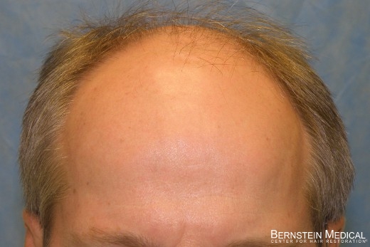 Click image for larger version

Name:	03_before-hair-transplant.jpg

Size:	95.6 KB
ID:	42613