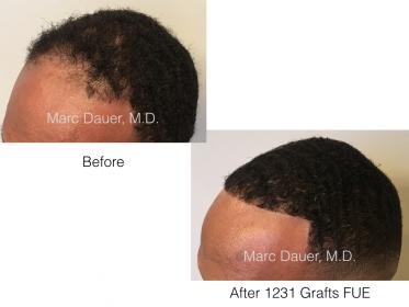 FUE African American Patient