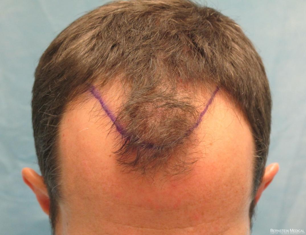 Position of Planned Hairline - Top View