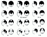 Norwood Scale - Male Pattern Baldness