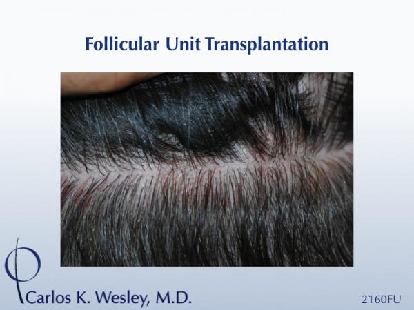 Donor scar after 2160 grafts 
Dr. Carlos K. Wesley in New York City