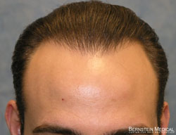 Click image for larger version

Name:	04_after-1st-hair-transplant.jpg

Size:	23.7 KB
ID:	24962