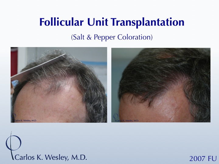 Before/After 2007 Grafts.
This patient underwent FUT.