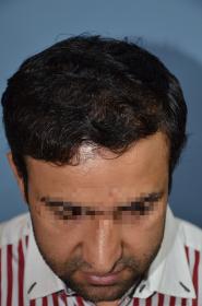 Click image for larger version

Name:	darling buds clinic hair transplant esult at 6 months in Indiia (6).jpg

Size:	8.4 KB
ID:	65987