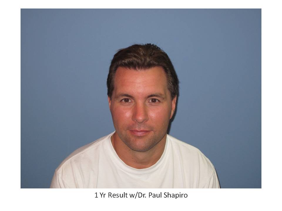 Dr. Paul Shapiro, MD  
FUT 
2164 grafts/ 4395 hairs 
12 months post-op