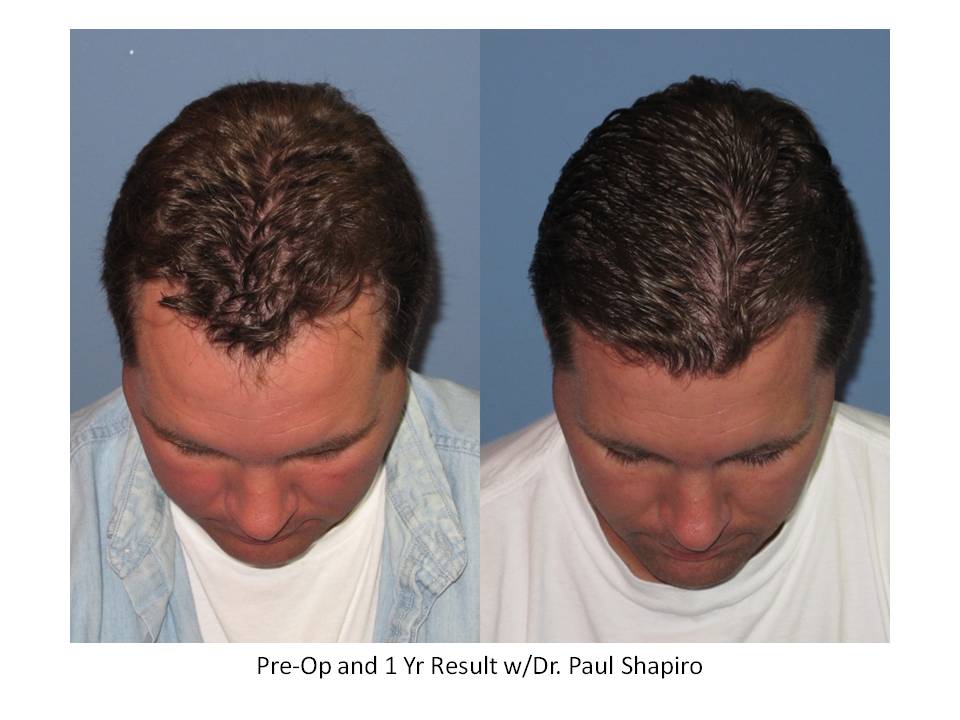 Dr. Paul Shapiro, MD  
FUT 
2164 grafts/ 4395 hairs 
12 months post-op