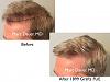 Click image for larger version

Name:	Hair Transplant Slides copy86.002.jpg

Size:	13.5 KB
ID:	47743