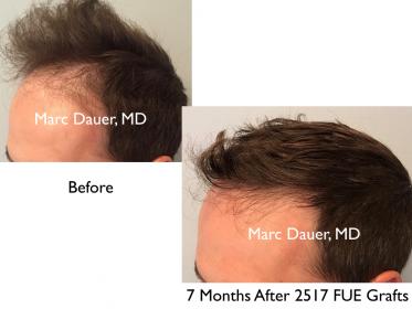 Click image for larger version

Name:	Hair Transplant Slides copy25.002.jpg

Size:	13.4 KB
ID:	45963