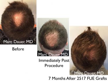 Click image for larger version

Name:	Hair Transplant Slides copy25.005.jpg

Size:	17.1 KB
ID:	45966