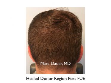 Click image for larger version

Name:	Hair Transplant Slides copy25.006.jpg

Size:	12.2 KB
ID:	45967