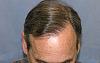 Click image for larger version

Name:	Top of Head and Hair Line This is After Second Session.jpg

Size:	21.0 KB
ID:	353