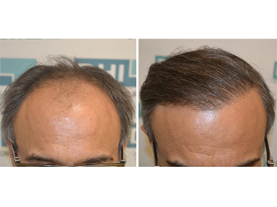3,598 Hair implanted. 20 months result