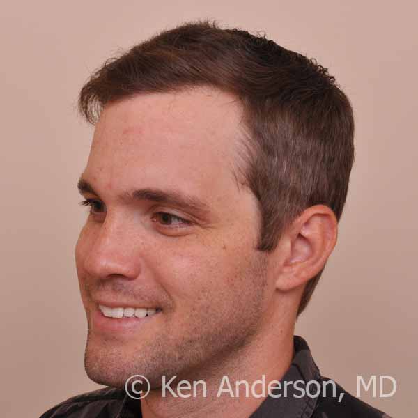 Dr. Ken Anderson - 32 year old Norwood 3 - ARTAS and PRP with ACell - 14 month post-procedure results