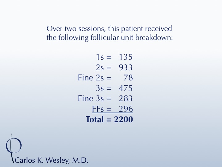 A 35-year-old African-American male underwent a 2200 FU session with Dr. Carlos K. Wesley (NYC).