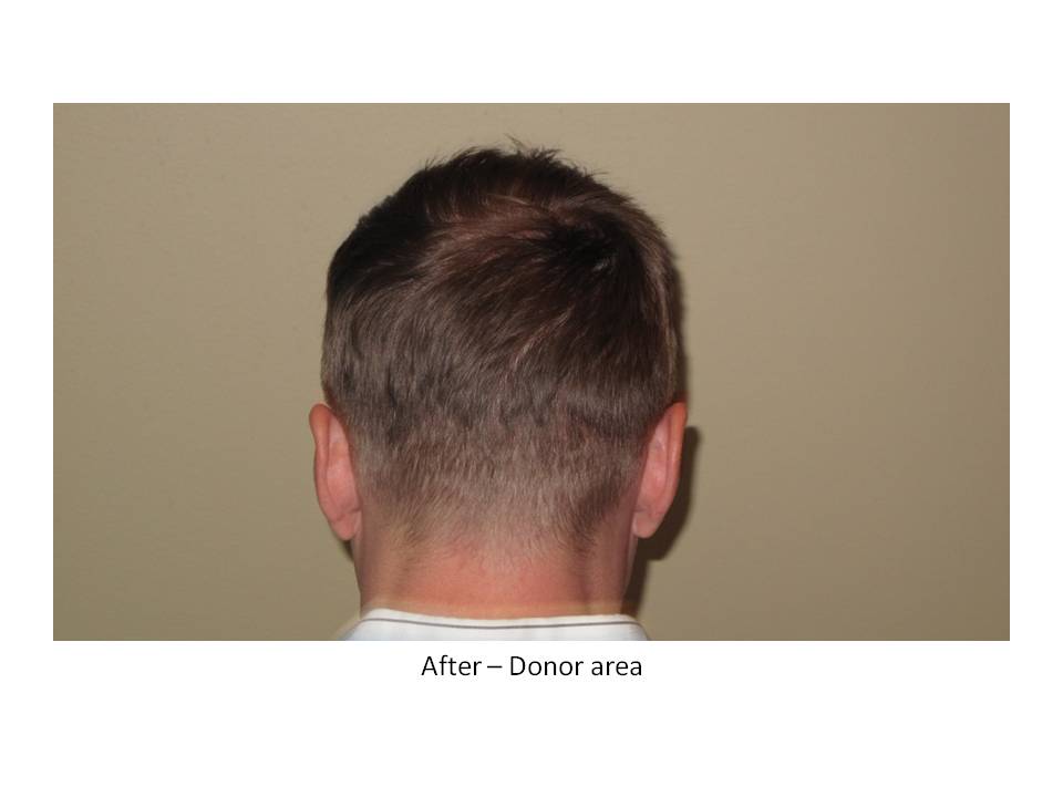 Dr. Paul Shapiro, MD  
FUT  
5207 grafts/ 11,661 hairs 
3 surgical sessions 
12 months post-op session 3