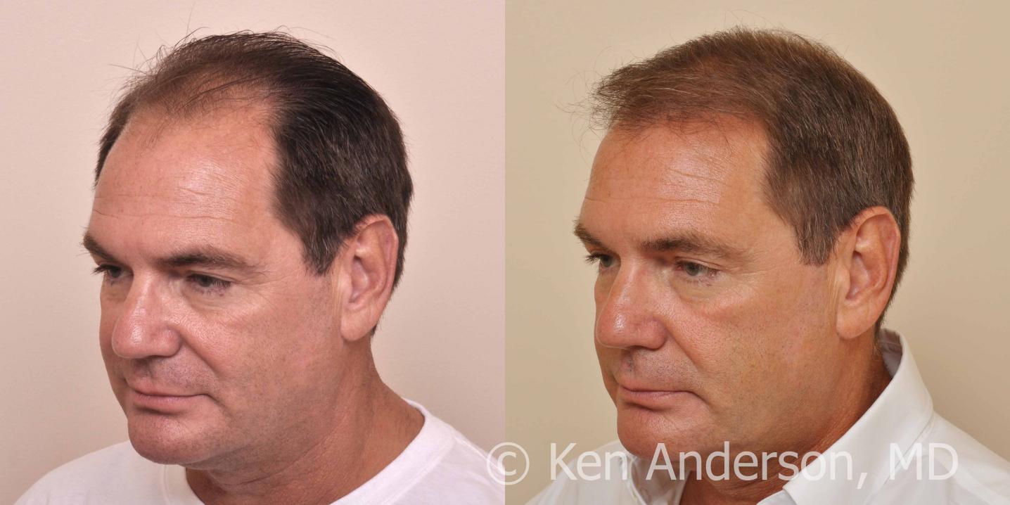 57 year old man who had an ARTAS Robotic Hair Transplant by Dr. Ken Anderson, at the Anderson Center for Hair in Atlanta, Georgia.