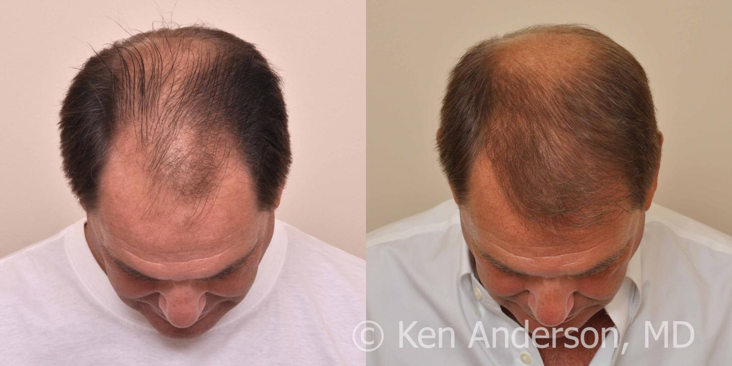 57 year old man who had an ARTAS Robotic Hair Transplant by Dr. Ken Anderson, at the Anderson Center for Hair in Atlanta, Georgia.