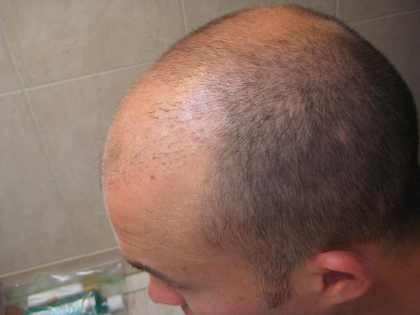 Hairline with old grafts (dark stubble) prior to first removal operation.  When I used to wear my hair long, the grafts would grow in frizzy....