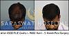 Repair Hair Transplant Results in Agra