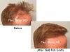 Click image for larger version

Name:	Hair Transplant Slides copy91.002.jpg

Size:	13.2 KB
ID:	47905