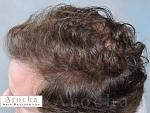 Twenty-nine year gentleman wanted to have a natural looking hair transplant to restore the framing of his face. Arocha Hair Restoration performed a...
