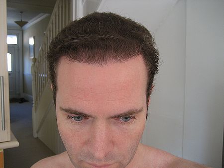 Photos taken in 2011 
All photos 5 years on from H&W surgery in 2006 
1 year from hairline refinement on 2010