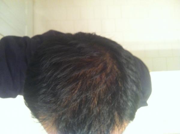 Aerial view of head combed to the side.