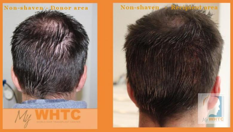 Click image for larger version

Name:	Non shaven donor and recipient areas pre and postop.jpg

Size:	45.0 KB
ID:	59618