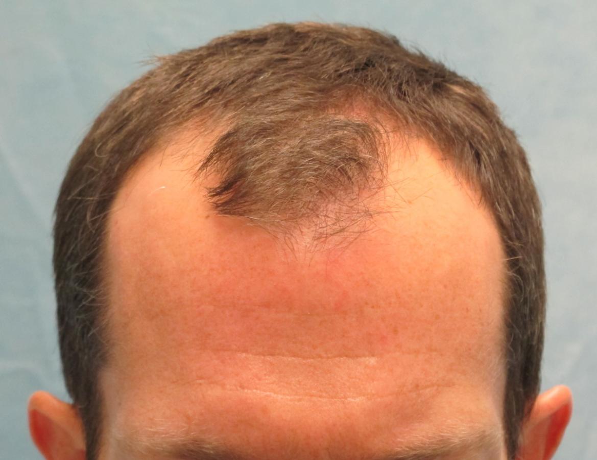 Click image for larger version

Name:	1a_before-hair-transplant_gkl.jpg

Size:	85.4 KB
ID:	46260