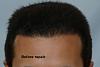 Click image for larger version

Name:	LowHairlineRepair.jpg

Size:	80.1 KB
ID:	20003