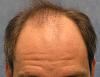 Click image for larger version

Name:	03_before-hair-transplant.jpg

Size:	52.0 KB
ID:	7197