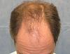 Click image for larger version

Name:	07_before-hair-transplant-top-view.jpg

Size:	53.1 KB
ID:	7201