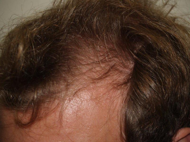 Before Hair Transplant Procedure