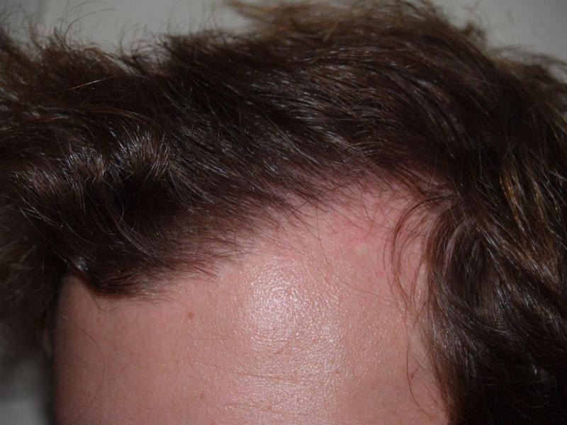 After Hair Transplant Procedure